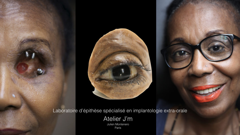 Prothèse de l'orbite