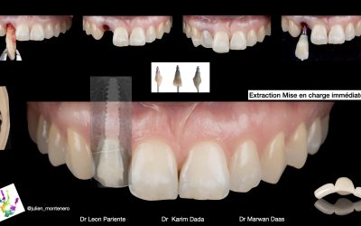 PROTHESE_DENTAIRE_MCI